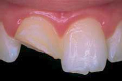 Dente anterior lascado