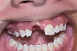 Avulsão de um dente permanente