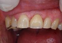 Colocação de Implante Dentário