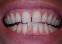 Dentes previamente branqueados com pigmento