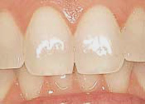Dentes manchados ou descolorados