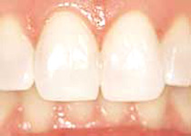Dentes após branqueamento 