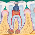 Uma cárie dentária profunda 