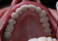 Vista Oclusal - Coroas e Implantes 